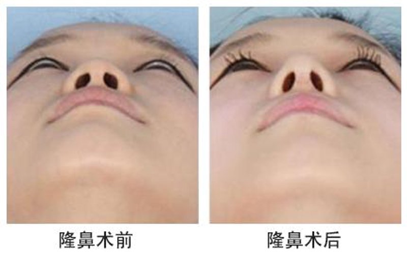 双眼皮手术价格:揭秘行业动态