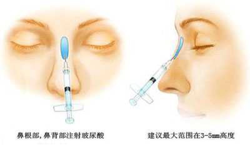 玻尿酸注射隆鼻